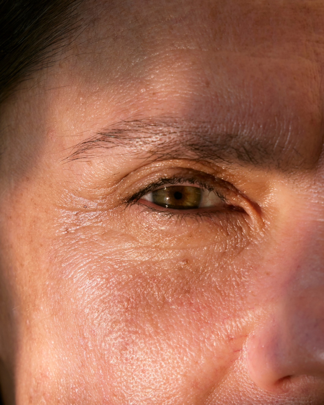 Lines & expression Fine lines around the eye
